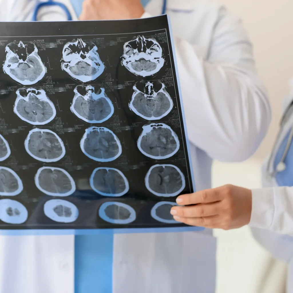 Médico sosteniendo escáner cerebral, simbolizando la importancia de realizar una evaluación neuropsicológica en casos de demencia en Murcia.